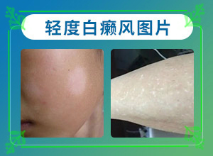 [有哪些方法可以緩解]白殿風(fēng)長(zhǎng)在臉上好治嗎