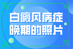 {解決方案}-輕度白癩風能治愈嗎?