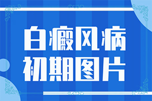 孩子有白殿風[癥狀比對]寶寶白癩風初期癥狀