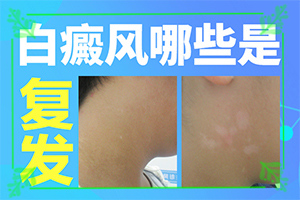 白癲風(fēng)早期是什么樣,剛發(fā)現(xiàn)的白斑(怎么能看出長啥樣的)