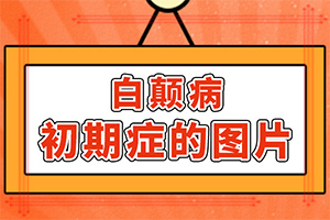 [白癜風(fēng)容易治療嗎小孩白點癲風(fēng)可以治好嗎