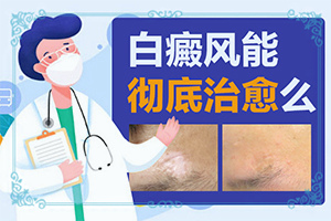 白癩風(fēng)有哪些的癥狀,患上了會出現(xiàn)哪些癥狀(好發(fā)部位有哪些)