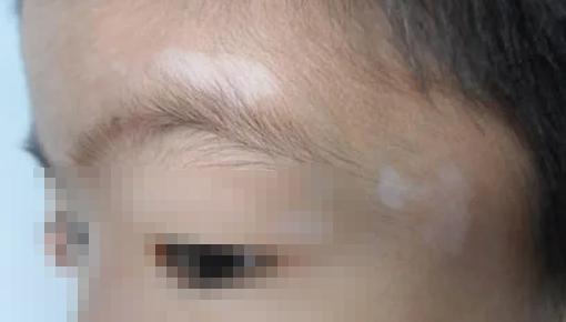 小孩身上有白斑怎么辦？