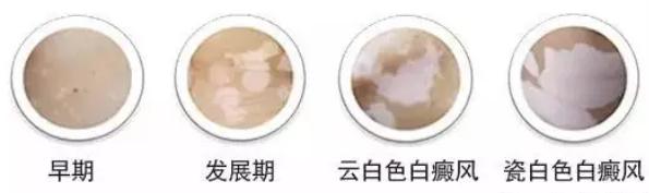 皮損類型