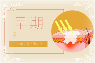 白點(diǎn)風(fēng)病情發(fā)作后白斑癥狀，你了解了嗎