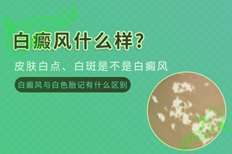 頸部白癩風(fēng)發(fā)作的因素，原來(lái)是生活中容易忽視的細(xì)節(jié)