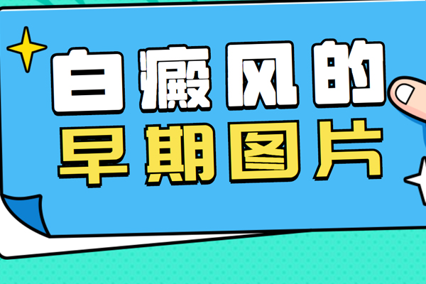白癩風(白斑)的初期圖片-白斑都是白癜風嗎?白癜風的癥狀表現都有哪些?