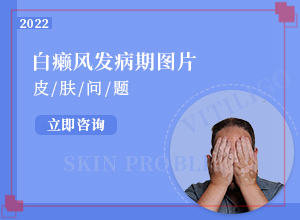 20多年的白斑了沒(méi)有擴(kuò)散 可以怎么治（怎么治療比較好）