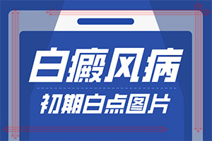手上有白班是怎么回事[癥狀有什么變化啊]白點(diǎn)癲風(fēng)的圖片