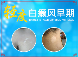 早期可以白癩風(fēng)癥狀,典型表現(xiàn)(好轉(zhuǎn)癥狀有哪些)