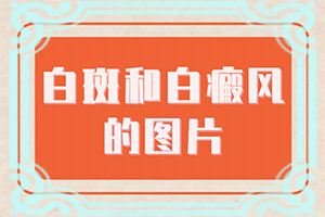 小腿長(zhǎng)白班是什么原因[怎樣判斷癥狀]白殿風(fēng)初期癥狀和圖片