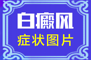 輕度白癩風(fēng)臉部圖片,發(fā)病特點(diǎn)(怎么能看出長(zhǎng)啥樣的)