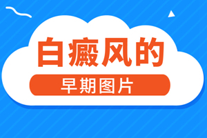 [大揭秘]白癜風(fēng)一直治不好是什么情況-白癜風(fēng)發(fā)病原因-是什么阻礙著白癜風(fēng)治療的進(jìn)度