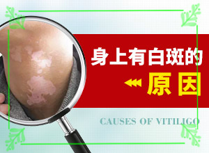 白癩風(fēng)與白斑,怎么診斷鑒別(出現(xiàn)的癥狀是什么)