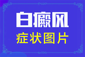 [這有幾種好方法]兒童白點癲風(fēng)可以治好嗎