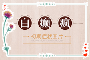 白癲瘋怎么治療好？[怎么治療比較好]兒童白癩癜風(fēng)能嗎