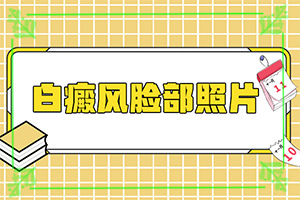 得白癜風(fēng)的概率-孕婦患有白癜風(fēng)會遺傳給胎兒嘛