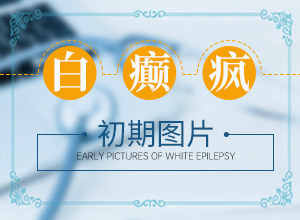 白癩風與白斑[怎么診斷鑒別]臉上有白班是怎么回事