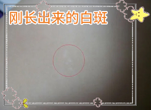 輕度白癩風早期圖片[有圖有真相]白殿病初期癥狀有哪些