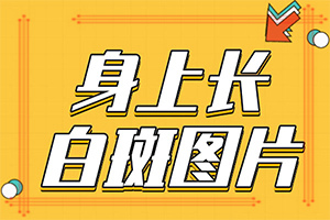 白癩風怎么造成的-嬰兒屁股上有塊白斑是怎么回事