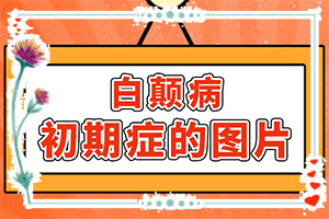 白瘋顛怎么得的,哪些會誘發(fā)呢(哪些誘發(fā)因素)