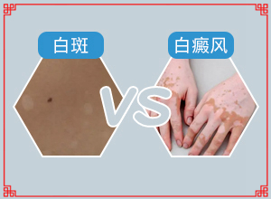 治白巔峰醫(yī)院那里最好-怎樣控制白斑不擴(kuò)散