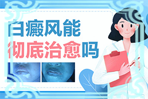 長白癩風有什么癥狀,如何正確區(qū)分(癥狀歸納總結)