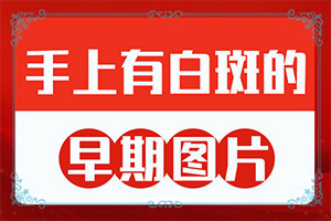 [白斑治療常識(shí)有哪些]那里看白癲效果好