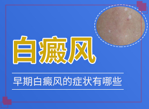 [治療要注意哪些]白癩風能治療好嗎