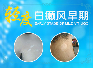 外傷引起瞳孔白斑能治療好嗎。,常見誘因有哪些(發(fā)生因素有哪些)