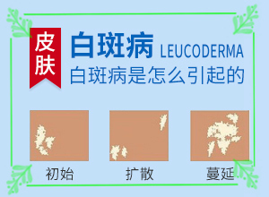 白點癲風好治療嗎[治療效果怎么樣]治療兒童癲方法