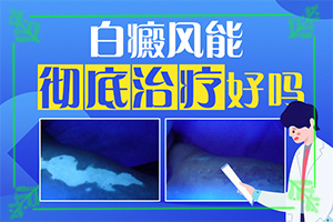孩子臉上白塊-有什么不同之處