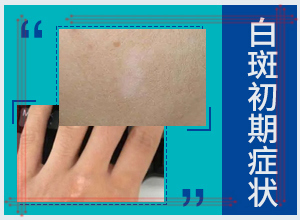 白風(fēng)癲早期癥狀圖,發(fā)生時的特點(diǎn)有(常見的癥狀會有哪些呢)